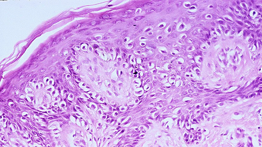 What is a 'melanoma'?